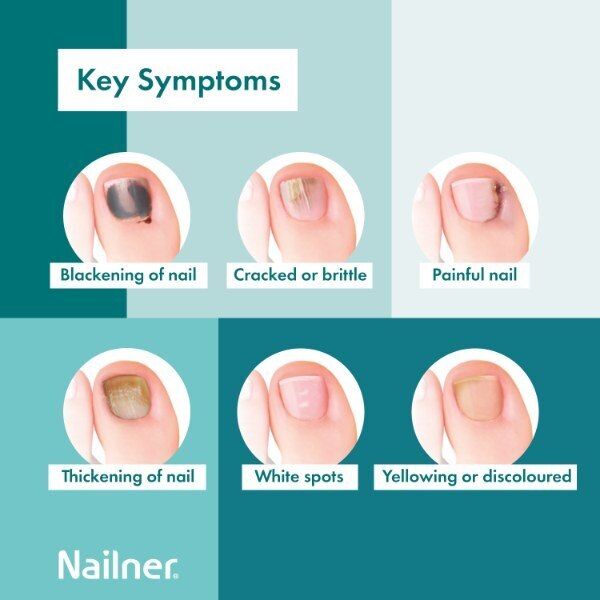 Nailner Active Cover Nail Fungus Treatment Natural Nude