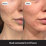 Hero Mighty Pimple Patches Invisible 24