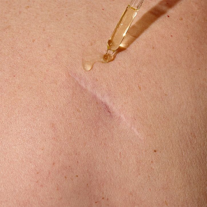 Balmonds Scar & Stretchmark Oil 50ml - McGrocer