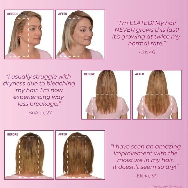 BosleyMD  Hair Loss Prevention Starter Pack MendXtend - McGrocer