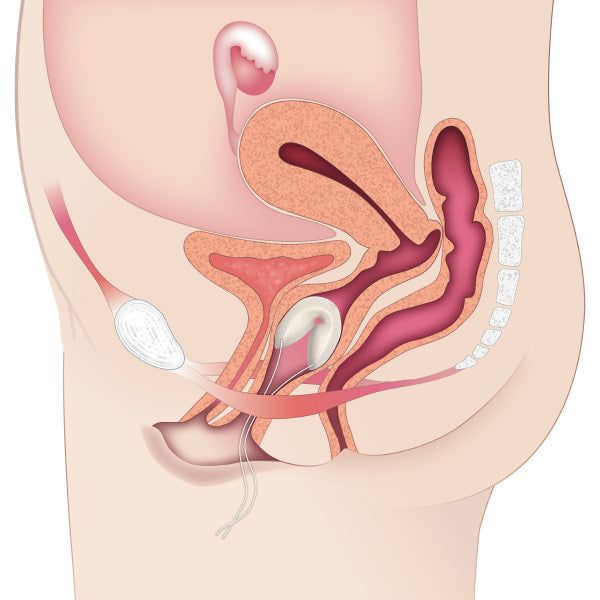 Contrelle Activgard Sizing Kit
