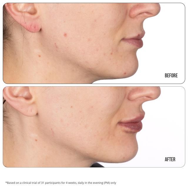 Nip+Fab Retinol Fix Blemish Treatment Gel 10%   15ml