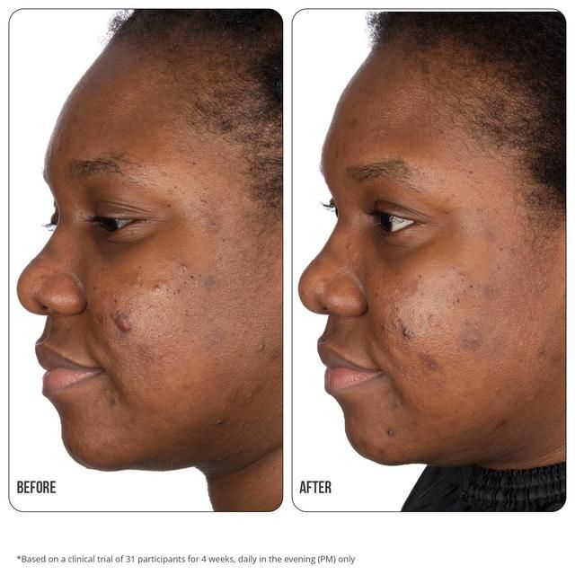 Nip+Fab Retinol Fix Blemish Treatment Gel 10%   15ml