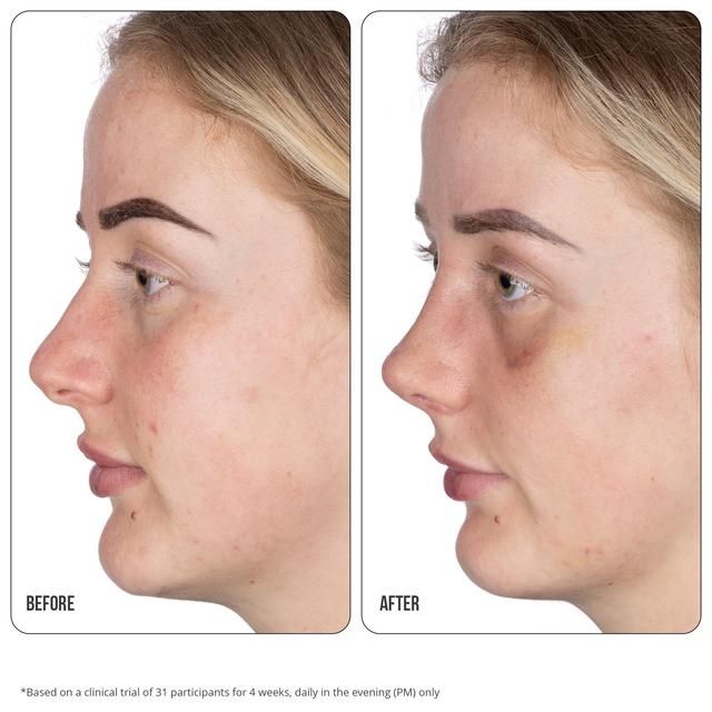 Nip+Fab Retinol Fix Blemish Treatment Gel 10%   15ml