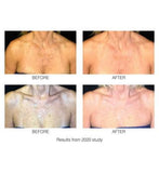 Rio DecoLITE Beauty boost LED light Treatment